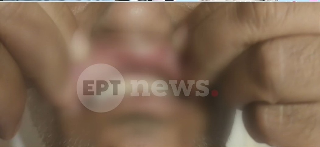 Επίθεση σε οδηγό λεωφορείου του ΟΑΣΑ από επιβάτη: Του έσπασε το ζυγωματικό και τον τραυμάτισε σε μάτι και ούλα