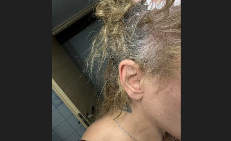 «Μου έβγαλε τούφες από τα μαλλιά» – Η γυναίκα που ξυλοκοπήθηκε από γνωστό επιχειρηματία κέντρου αισθητικής μίλησε στο ΕΡΤnews