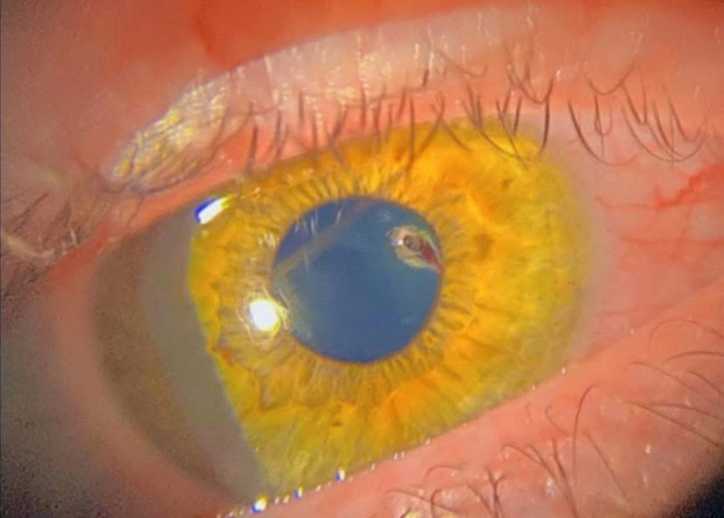 Χανιά: Με επιτυχία ολοκληρώθηκε χειρουργική επέμβαση σε 23χρονο που είχε τραυματιστεί σοβαρά στο μάτι