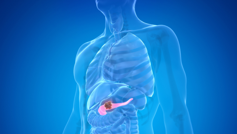 Καρκίνος του παγκρέατος: Πρωτοποριακή έρευνα αποκάλυψε γονιδιακά μοτίβα που σχετίζονται με τη νόσο