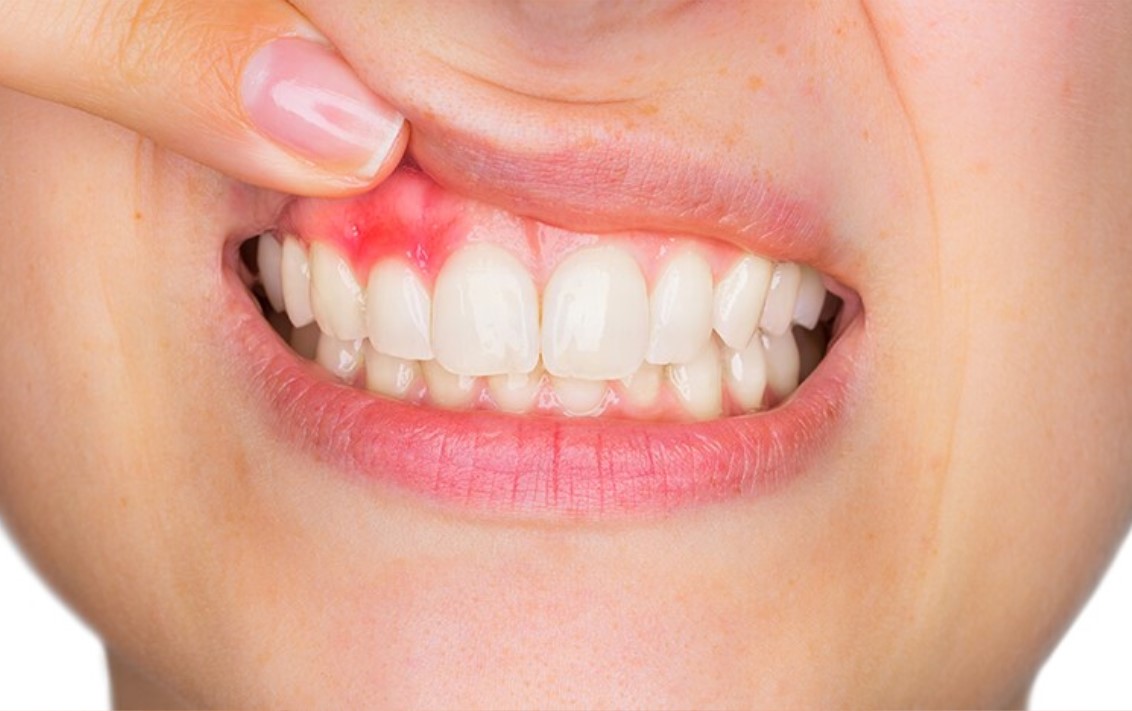 Περιοδοντίτιδα: Αίτια, διάγνωση και θεραπεία