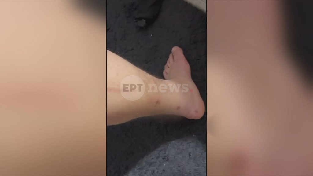 Αίγιο: Με σκάγια από φυσίγγια για κυνήγι μεγάλων θηραμάτων πυροβόλησε τους ανήλικους ο 46χρονος – Αποκλειστικές φωτογραφίες των τραυμάτων