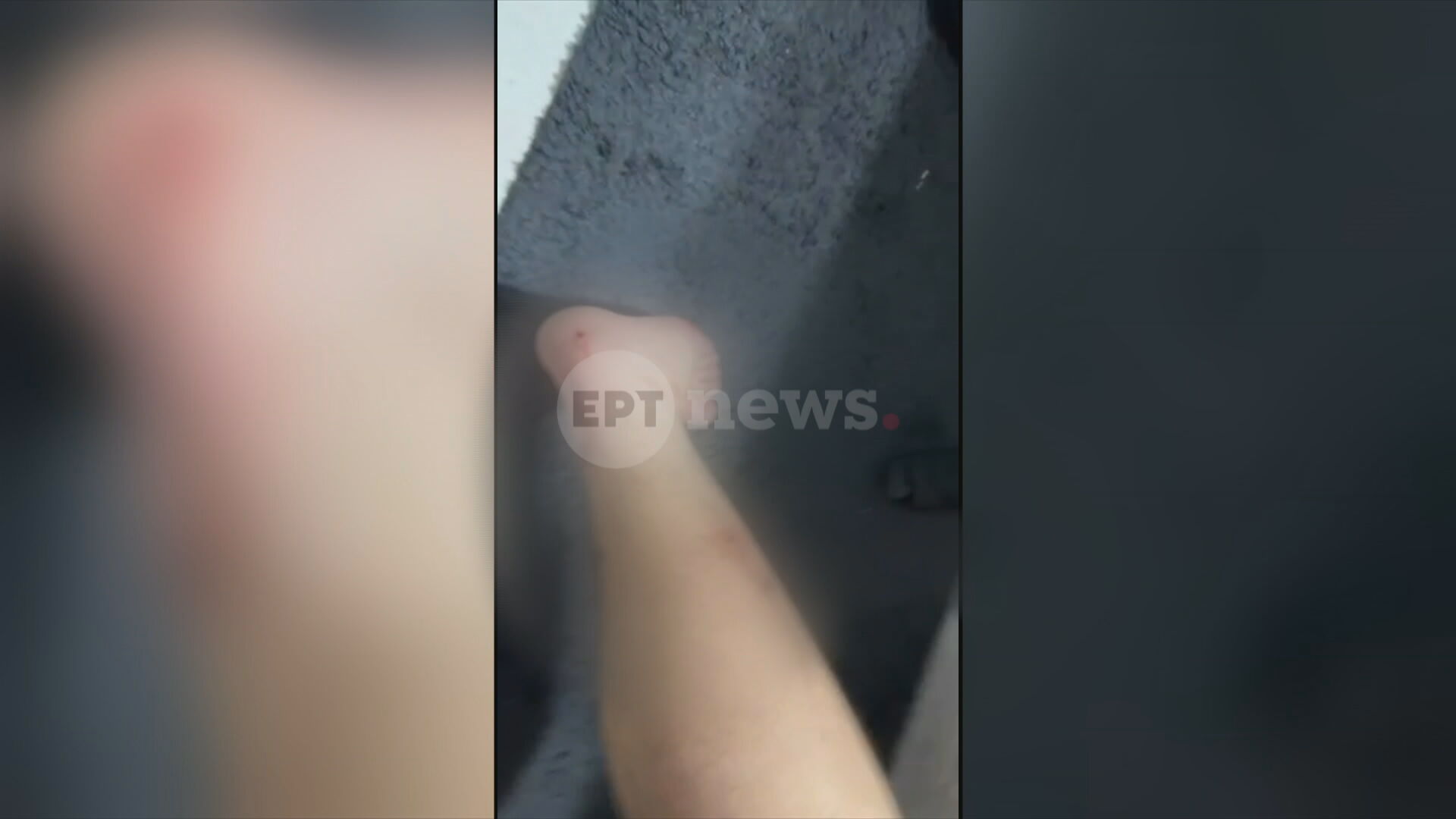 aigio3 Αίγιο: Με σκάγια από φυσίγγια για κυνήγι μεγάλων θηραμάτων πυροβόλησε τους ανήλικους ο 46χρονος – Αποκλειστικές φωτογραφίες των τραυμάτων