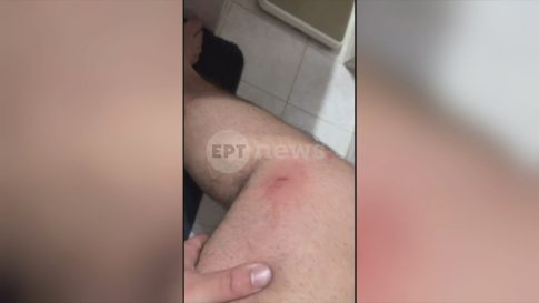 Δράση βελονισμού στο Θεαγένειο – Παρέμβαση για την ανακούφιση από τις παρενέργειες των θεραπειών