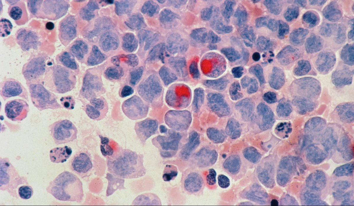 Πρόληψη καρκίνου: 4 στις 10 περιπτώσεις μπορούν να αποφευχθούν – Τι δείχνουν τα στοιχεία