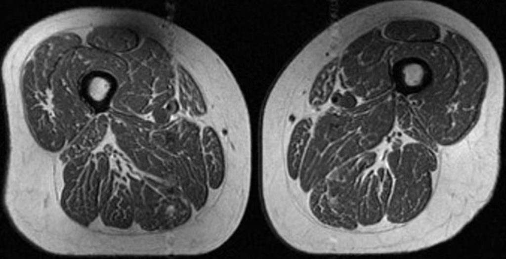Προειδοποίηση επιστημόνων για τα υπερεπεξεργασμένα τρόφιμα: Η μαγνητική γυναίκας με τους μηρούς-μπριζόλα και ο «σιωπηλός» κίνδυνος