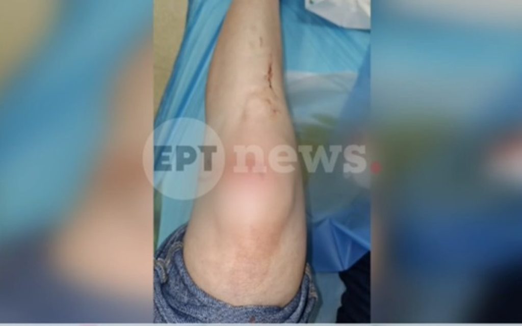 Πάτρα: «Μου έσπασαν το τζάμι και μου επιτέθηκαν» – Η μαρτυρία της γυναίκας που δέχθηκε επίθεση από τρία άτομα
